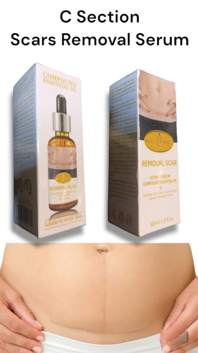 Acne Scar Removal Serum | Scar, C Section & Stretch Mark Removal Serum For Women