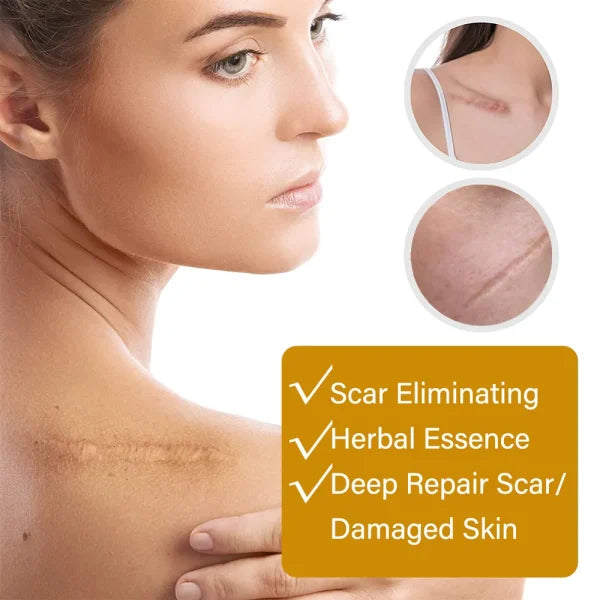 Acne Scar Removal Serum | Scar, C Section & Stretch Mark Removal Serum For Women