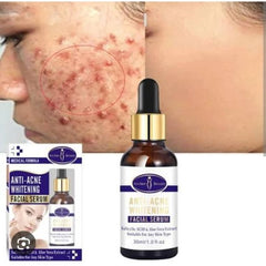 Anti-Acne Whitening Serum | Remove Acne Scars | 30ml