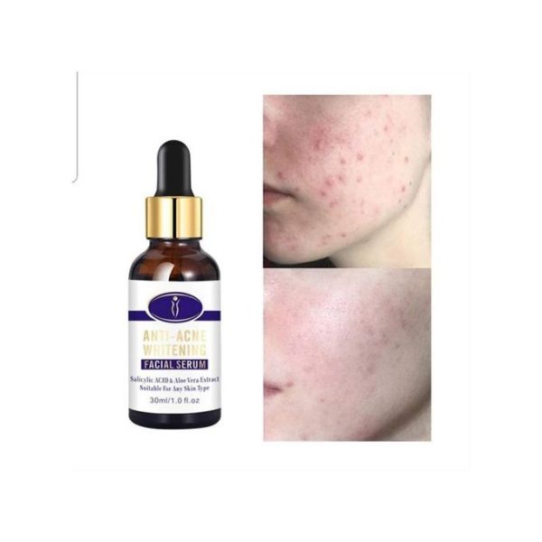 Anti-Acne Whitening Serum | Remove Acne Scars | 30ml